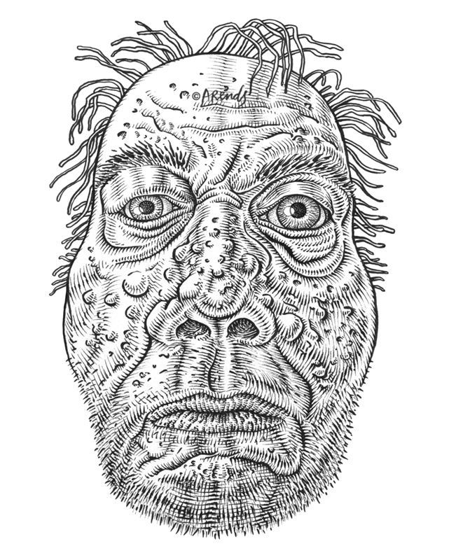 Rosacea